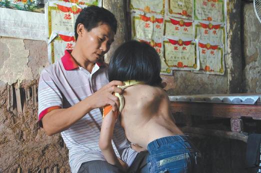有嚴重脊椎畸形及胸腔隆突病的李文霞。