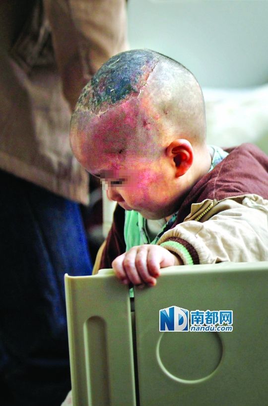 1月8日下午，小寶頭上和臉上都是傷痕。