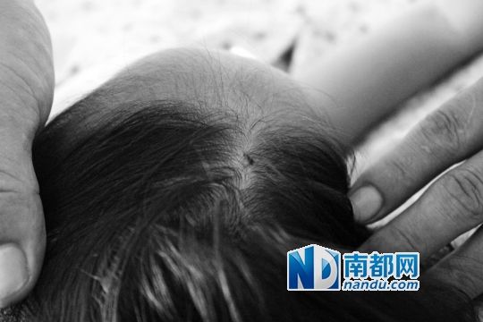 女童頭上被扎的針孔（圓圈處）。賈先生說，被扎不到三秒鐘，女兒就昏了。