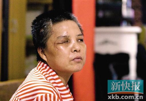 4月初,趙女士遭人搶劫并被打傷,現(xiàn)今右眼失明,頭部被縫100多針。記者 畢志毅/攝