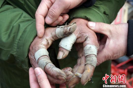 圖為由于常年拾荒，老人雙手布滿傷口。周小云 攝
