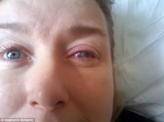 恐怖慎入！隱形眼鏡致英女子摘除眼球