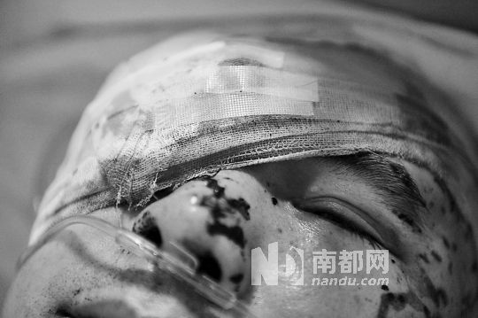 李建新頭部還有被潑硫酸的痕跡，醫(yī)生說被砍傷的右眼已經(jīng)失明。 南都記者 田飛 攝
