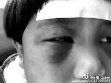 6月2日，網曝渭南市臨渭區(qū)一不滿5歲的女童遭奶奶毆打，眼圈青腫，引起網友關注，但孩子父母和爺爺均稱是摔倒導致。相關部門介入調查發(fā)現(xiàn)確為奶奶毆打所致，鑒于其身體原因已進行批評教育。