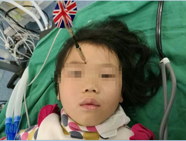 十多公分長的飛鏢穩(wěn)穩(wěn)地 ” 定 ” 在了一名六歲半的女童額頭上，小青一家人凌晨從長順趕到貴醫(yī)附院急診室時，看到如此慘烈的情況，接診醫(yī)生都嚇了一跳。詳細詢問下得知，原來是七歲的哥哥和六歲半的表妹在玩耍時，哥哥不慎將路邊撿來的真飛鏢扎到了妹妹的額頭上。