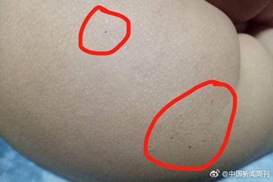 據(jù)多名紅黃藍(lán)(新天地分園)家長(zhǎng)反映，孩子腿部、屁股、腋下出現(xiàn)針眼。