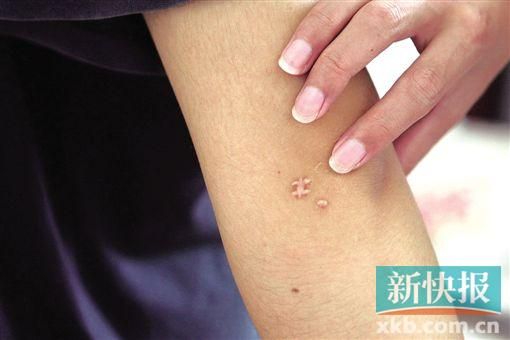 取出針后李星兒手臂留下了傷口。新快報(bào)記者 張國鋒/攝