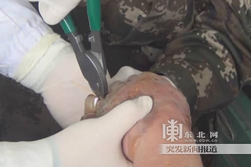 正在拆除戒指。