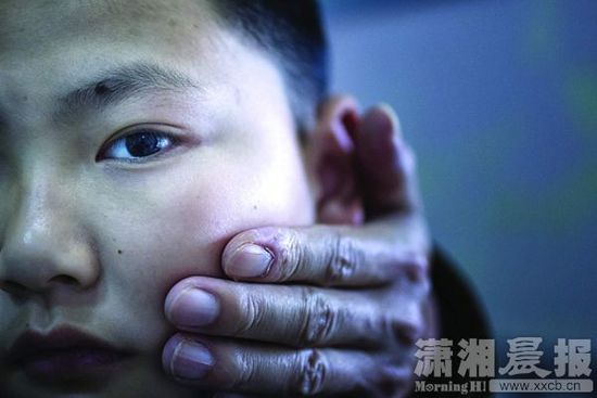 1月13日，小玨的父親心疼地摸著兒子的臉。