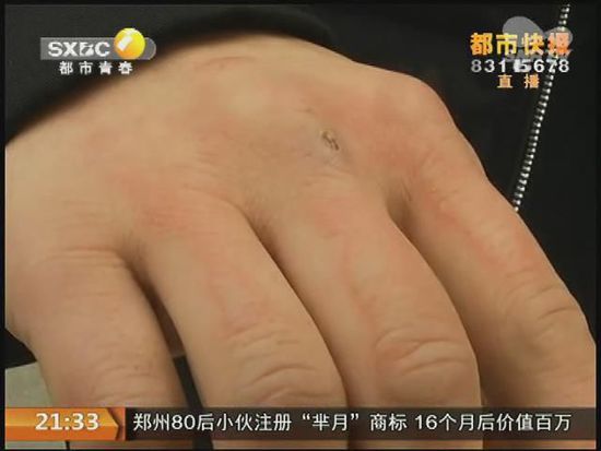 說到這足療拔罐，估計(jì)大伙都不陌生，但是想起4號(hào)晚上的拔罐的經(jīng)歷，呂先生現(xiàn)在想起來，還心有余悸。